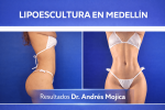 Foto de Excelencia en Cirugía Estética: Lipoescultura y Rinoplastia en Medellín con el Dr. Andrés Mojica