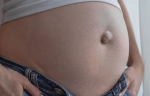 Foto de Hernia inguinal bilateral: decisiones prácticas y retorno seguro