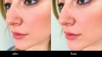 Foto de Antes y después de una rinoplastia: resultados reales en Bogotá