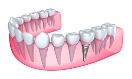 Implantes dentales y Edentulismo