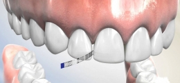 Stripping dental en Zaragoza