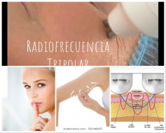 Lifting facial sin cirugía 