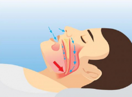 Apnea del sueño en síndrome de Down