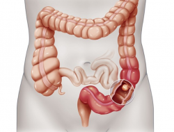 Practicas Ideas para tratarse del colon irritable