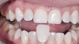 ¿Cómo tener unos dientes blancos y sanos?