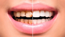 ¿Estás buscando carillas dentales en Madrid?
