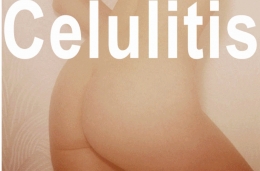 La celulitis tiene curación