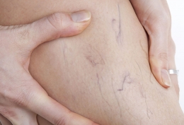 Cuándo y por qué tratar las varices para evitar complicaciones