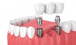 ¿Qué son los implantes de carga inmediata?