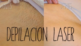 La depilacion laser como solución definitiva