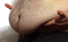 Diabetes y obesos