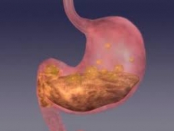 Como Tratar Naturalmente a la Gastritis