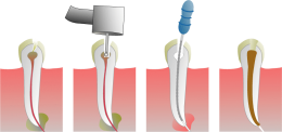 ¿Qué factores pueden provocar la necesidad de una endodoncia?