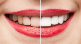 Cuánto cuesta un blanqueamiento dental en Ecuador
