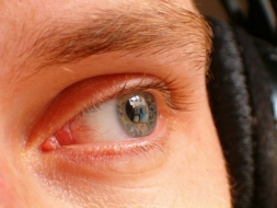 Información útil sobre la Blefaroplastia