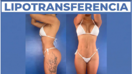 Lipotransferencia en Medellín