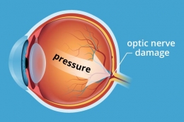 Cuando una tienda óptica ayuda a crear conciencia sobre el glaucoma