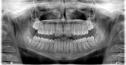 Alineamiento dental con la última tecnología