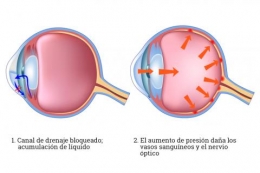 El implante para reducir la presión intraocular en el glaucoma es prometedor