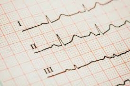 Tres formas de convertirse en un experto en ECG